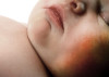 Red baby cheeks