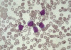 N0009936 Myelofibrosis, acute